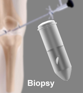 Open and Closed Biopsy