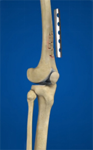 Curettage and Bone Graft of Benign Bone Lesions