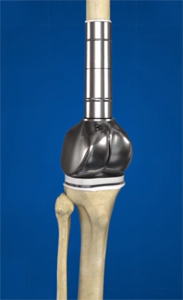 Distal Femur Resection and Reconstruction