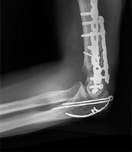 Distal Humerus Resection and Reconstruction