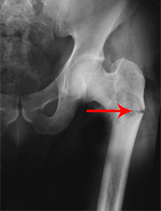 Bone cancer in the hip: Types, symptoms, and treatment