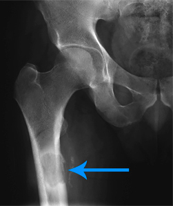 Metastatic Bone Disease