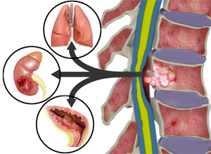 Metastatic Carcinoma