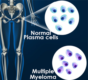 Multiple Myeloma and Amyloidosis