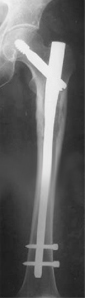 Prophylactic Femoral Nail