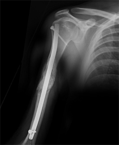  Prophylactic Humeral Nailing