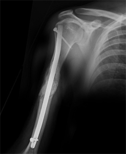 Prophylactic Humeral Nailing