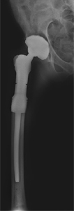 Proximal Femoral Resection and Reconstruction