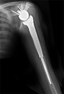 Proximal Humerus Resection and Reconstruction