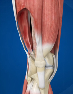 Resection of Soft Tissue Sarcoma