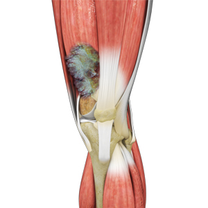 sarcoma