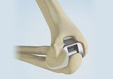 Total Elbow Arthroplasty